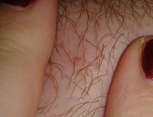 genitális szemölcsök kezelése