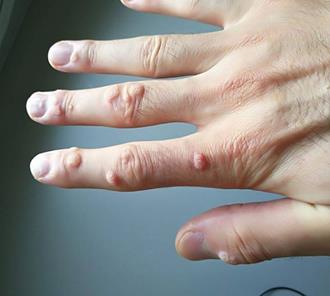 hogyan lehet gyorsan megszabadulni a szemölcsöktől