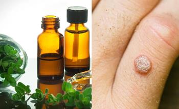 oregánó olaj papillómák és szemölcsök ellen